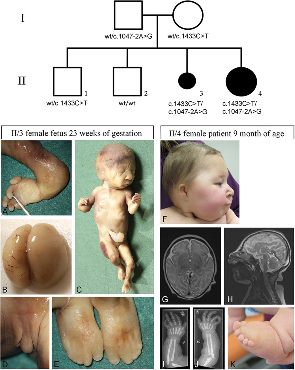 Picture of: Microcephaly, short stature, and limb abnormality disorder due to